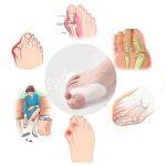 Stecca in Silicone per Correggere le Dita dei Piedi - immagine 6
